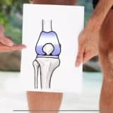 DİZ PROTEZ OPERASYONU SONRASI FOOT CORE EGZERSİZLERİNİN FONKSİYON ÜZERİNE ETKİSİ