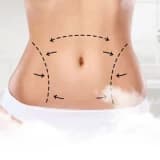 Karın Germe Ameliyatı Nasıl Olur?