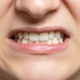 Diş Sıkma Bruksizm Nedir