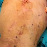 Efficiency of Prophylactic Ablation of the Tributary Venous Pathways Draining Around the Saphenofemoral Junction to Decrease the Rate of Future Varicose Vein and Symptoms Occurence