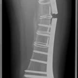 KIRIK İYİLEŞMESİ- Sessiz Mucize