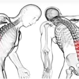 ANKİLOZAN SPONDİLİT HASTALIĞI, TANISI VE HASTAYI İYİLEŞTİRİCİ YAKLAŞIMLAR