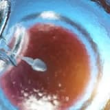 Tüp Bebek Tedavisinin Aşamaları