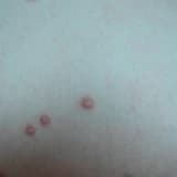 MOLLUSCUM CONTAGİOSUM