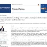 Secondary intention healing in the optimal management of common melanocytic nevi (moles on the face