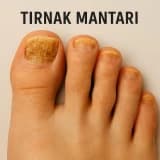 Tırnak Mantarı Kendiliğinden Geçer mi?