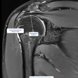 Rotator Manşet (Omuz Kas Yırtığı) Nedir?