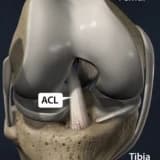 Ön çapraz bağ yaralanmaları ve tedavisi hakkında herşey