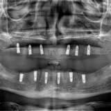 Dental İmplant