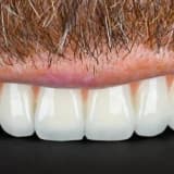 Zirkonyum Diş Nedir? Ne Kadar Dayanır, Doğal Görünür mü?