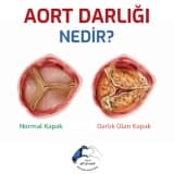 Aort darlığı nedir?