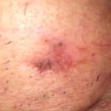 ERKEN EVRE MELANOM DIŞI DERİ KANSERİNDE (MDDK) KİŞİYE ÖZEL TEDAVİ Prof.Dr.Sıdıka Kurul Plastik Rekonstrüktif ve Estetik Cerrahi Uzmanı skurul@estet.net