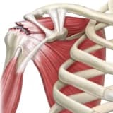 Omuzda Kas Yırtığı (Rotator Cuff Yırtığı) Hakkında Bilmeniz Gereken Her Şey