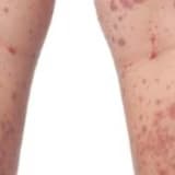 İmmünoglobulin A (IgA) Vasküliti Nedir? Belirtileri ve Tedavi Süreci