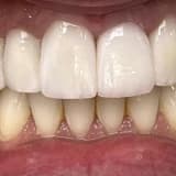 Porselen Lamine Nedir?