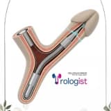 A Permanent Solution to Erectile Dysfunction: What Is a Penile Implant?