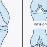 Ön Çapraz Bağ Ameliyatı Hakkında Bilgilendirme