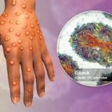 Monkeypox (Maymun Çiçeği Virüsü)