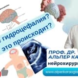 Что такое гидроцефалия? Почему это происходит?