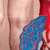 Kaplıca gibi sıcak yerler VARİSE iyi gelir mi?