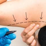 Kol Germe Ameliyatı Nedir?