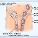 İnmemiş Testis Nedir? Erkek Bebeklerde İnmemiş Testis Neden Önemlidir?