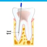KANAL TEDAVİSİNDE BAŞARISIZLIK NEDENLERİ