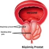 İYİ HUYLU PROSTAT BÜYÜMESİ (BENİGN PROSTAT HİPERPLAZİSİ, BPH)