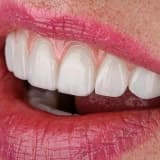 Gülüş Tasarımı Nedir? Daha Estetik Bir Gülüş İçin Neler Yapılır?