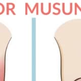 Batık Tırnak Probleminize Uygun Bir Çözüm