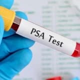 Psa testi nedir ve ne zaman yapılmalıdır?