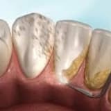 Diş Taşı Temizliği Neden Önemli?