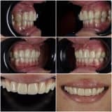 Diş Hekimliğinde Kullanılan Zirkonyum Materyaller