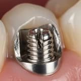 İmplant Vida Kırılması veya Gevşemesi Durumunda Ne Yapılır?