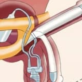 Penil Protez: Nedir, Nasıl Çalışır ve Kimler İçin Uygundur?
