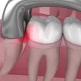 20'LİK DİŞ ÇEKİMİ