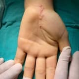 Karpal Tünel Sendromu