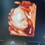 Detaylı Ultrason: Tanımı, Uygulama Yöntemleri ve Zamanlaması