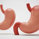 Tüp Mide Ameliyatı Sonrası Mide Tekrar Büyür mü?