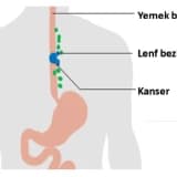 Yemek Borusu Kanseri