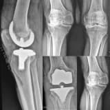 DİZ ARTROZU (KİREÇLENMESİ) VE TOTAL DİZ PROTEZİ