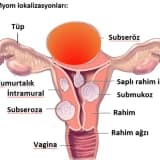 ENDOMETRİAL POLİP TEDAVİSİ