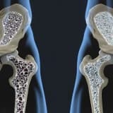 Osteoporoz (Kemik erimesi)