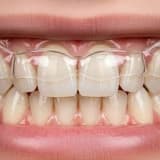 Bruksizm Nedir? (Diş Sıkma ve Gıcırdatma) Belirtileri, Nedenleri ve Tedavisi