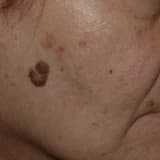 Malignant Melanoma