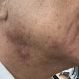 PSODOFOLİKÜLİTİS BARBA YANİ TIRAŞ ŞİŞLİKLERİ