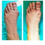 HALLUKS VALGUS / AYAK BAŞPARMAK ÇIKINTISI