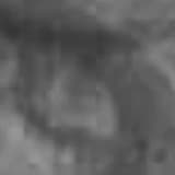 Neutrophil to lymphocyte ratio may be a predictive marker of poor prognosis in Legg-Calvé-Perthes disease