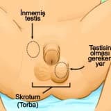 İnmemiş testis (kriptorkidizm) ve asansör testis (retraktil testis) nedir?