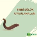 Tıbbi sülük uygulamaları